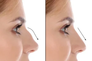 nose surgery