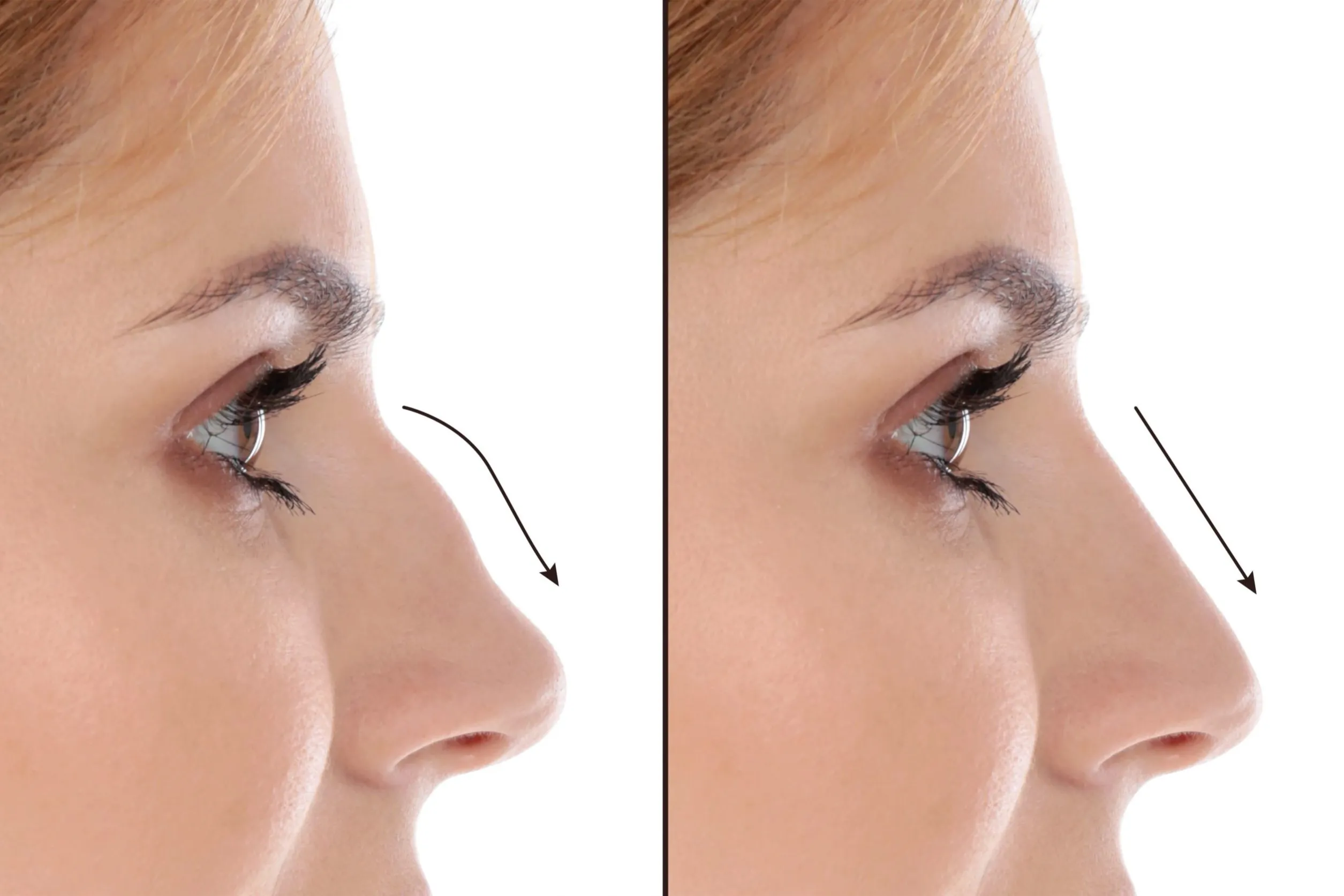 nose surgery